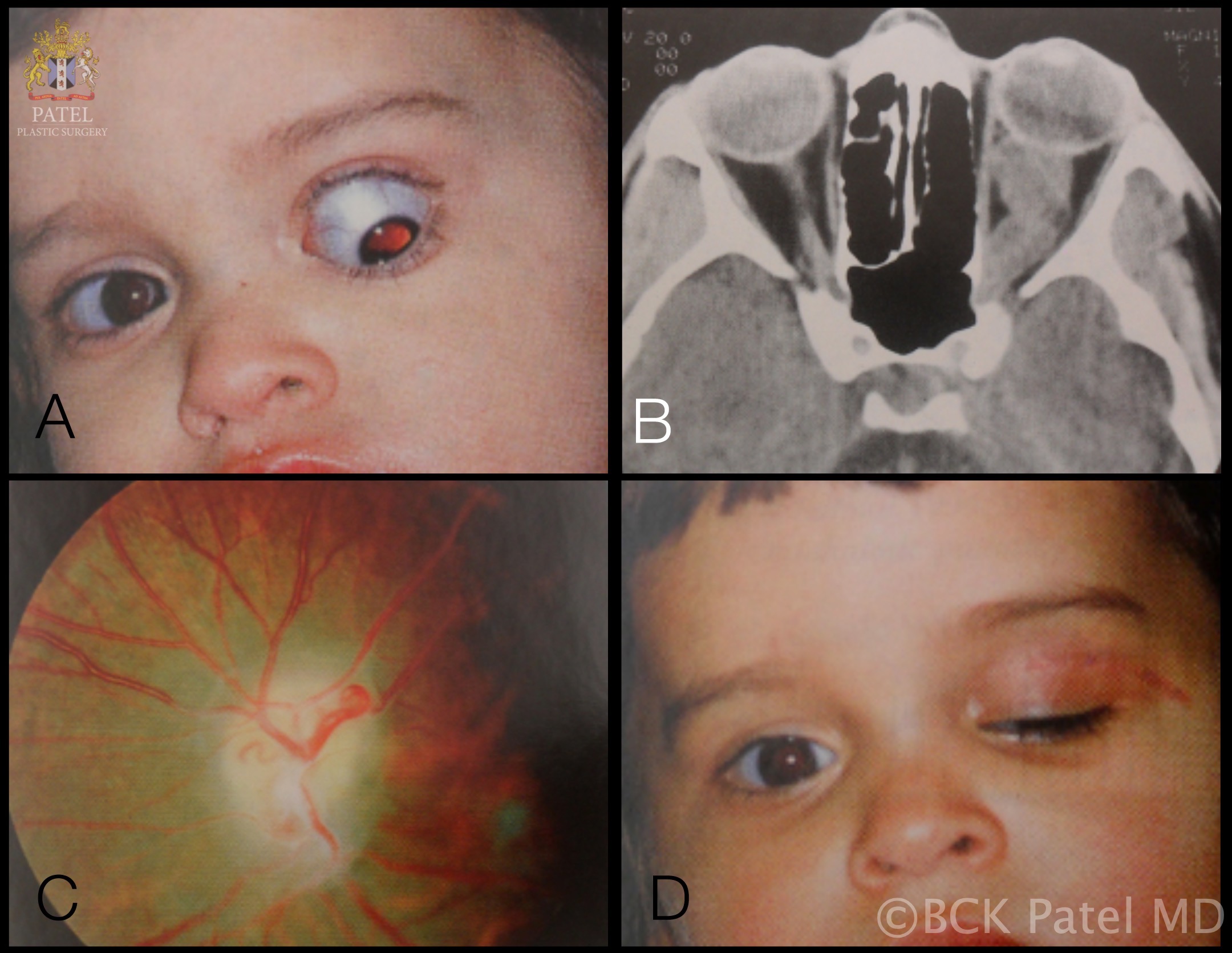 Optic nerve glioma