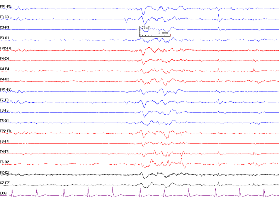 Burst suppression pattern