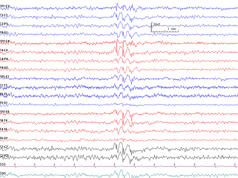 Generalized spike and wave