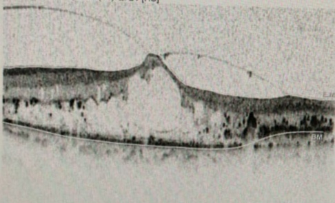 SD-OCT (macular scan) showing  Vitreo-macular traction (VMT) syndrome