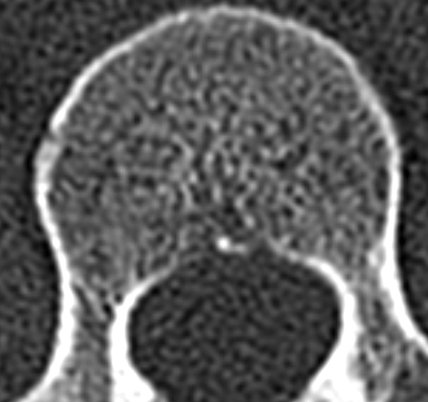 T11 vertebral bod hemangioma.