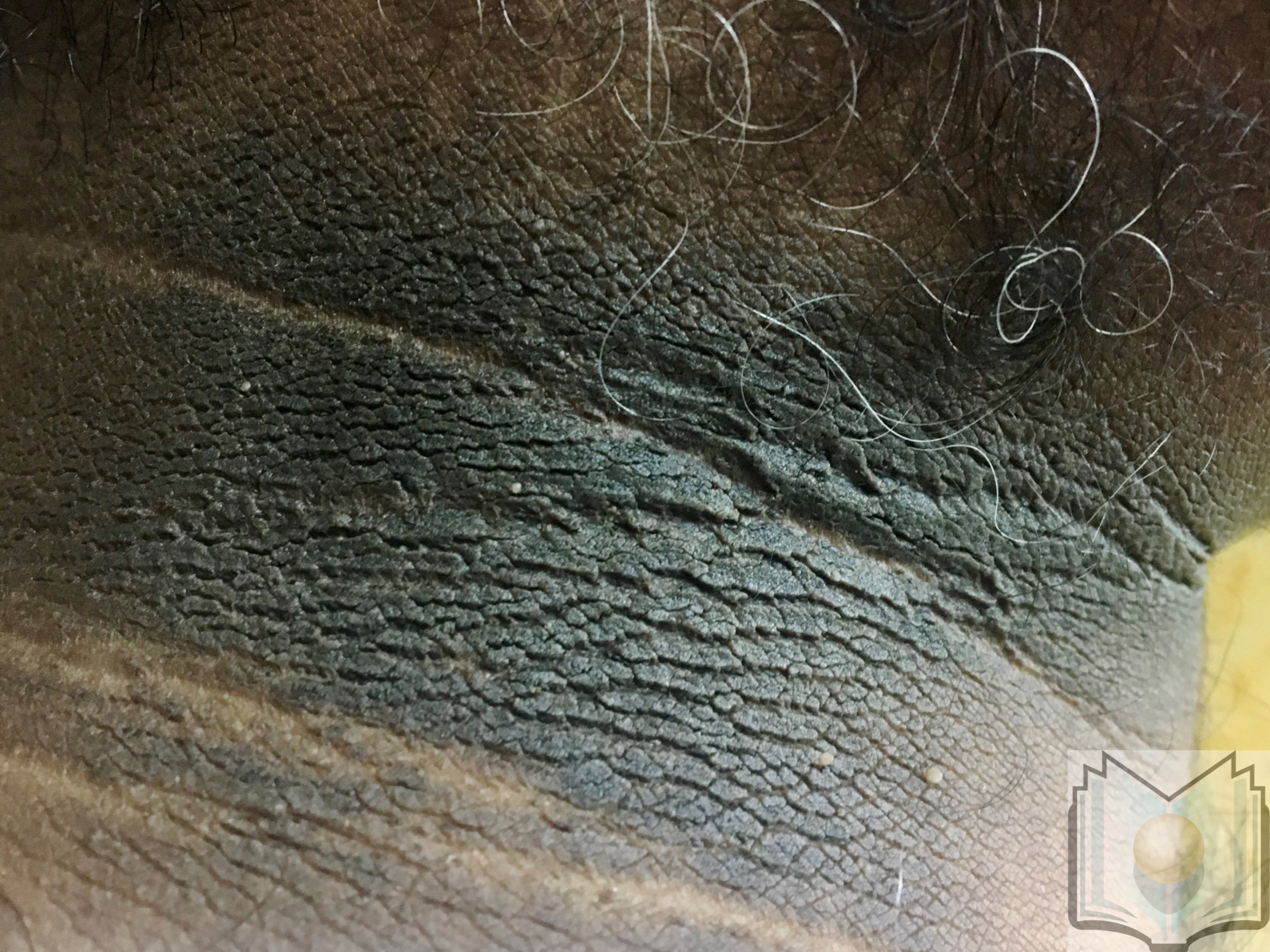 Acanthosis nigricans SV2