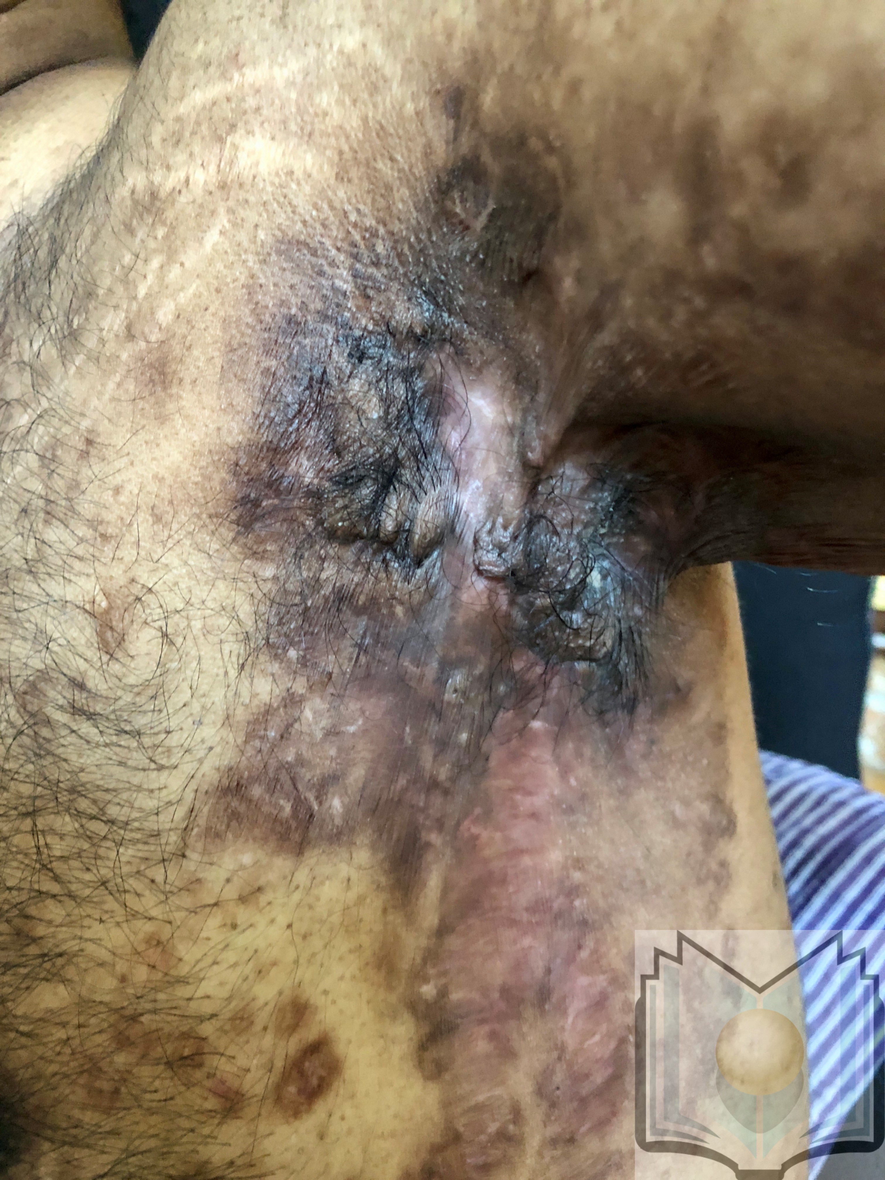 Hidradenitis Suppurativa 01