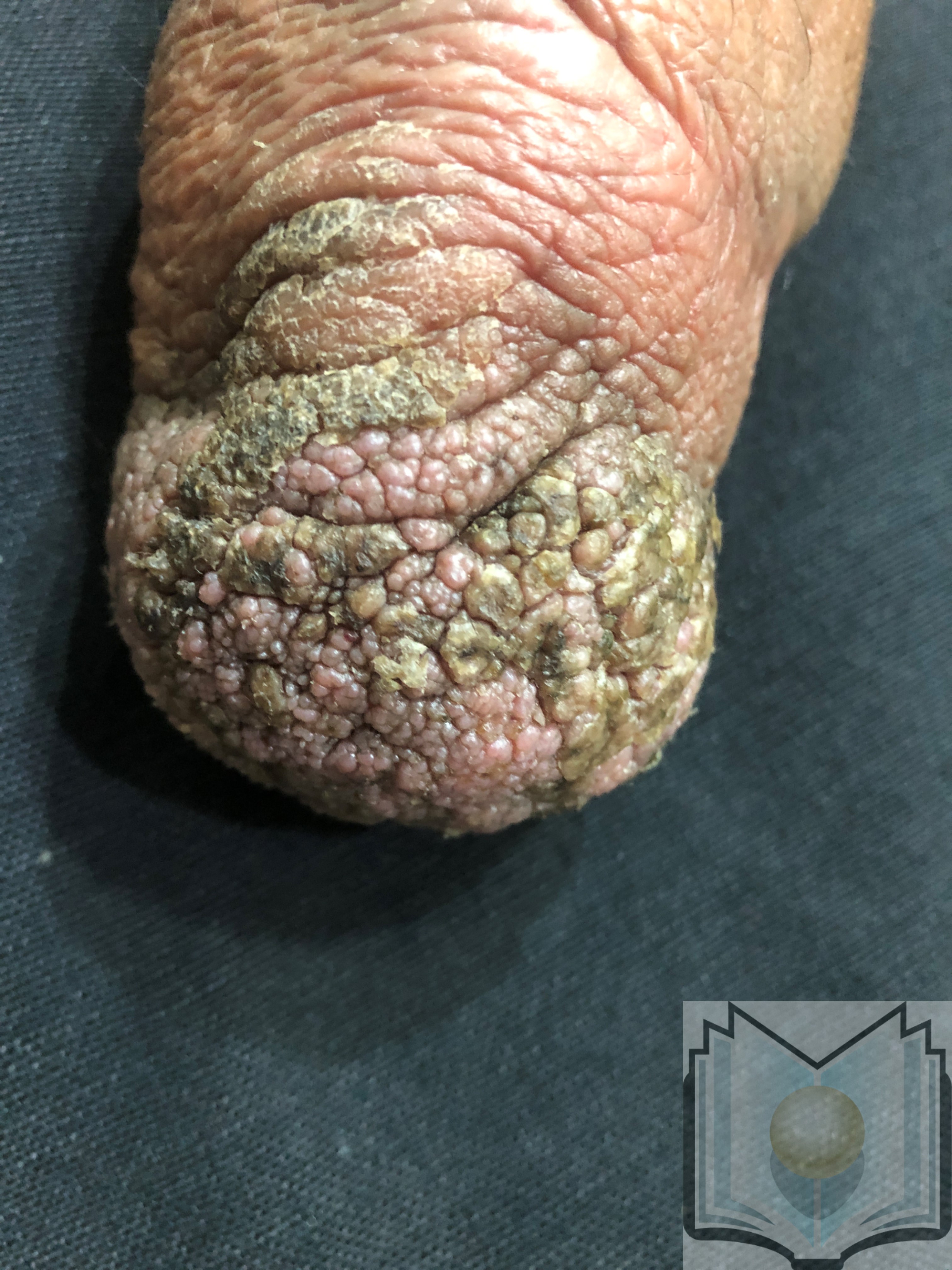 Verrucous Hyperplasia on Amputation Stump