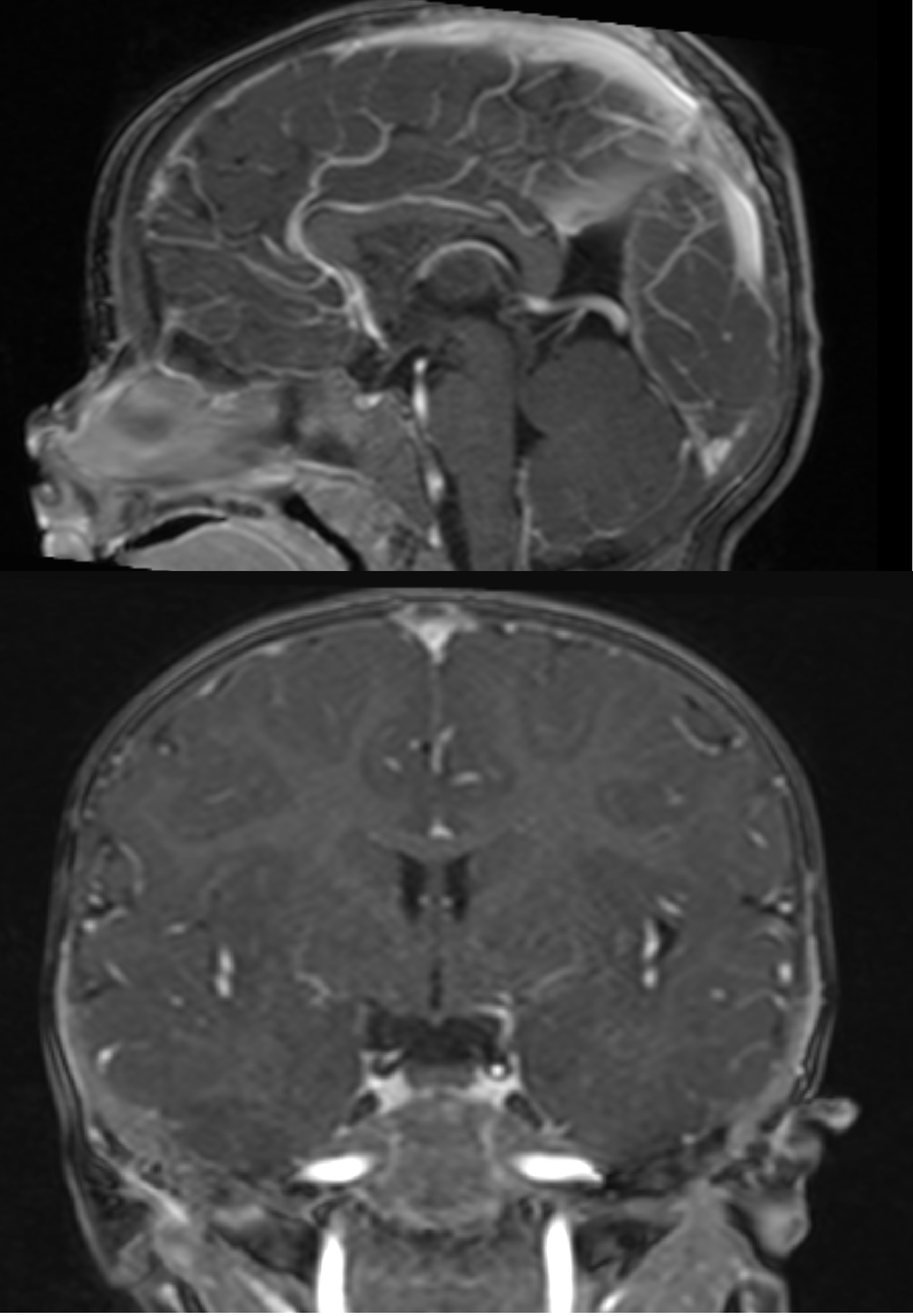 Contrast enhanced T1 images. Sagittal and coronal slices.