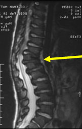 Congenital kyphosis MRI