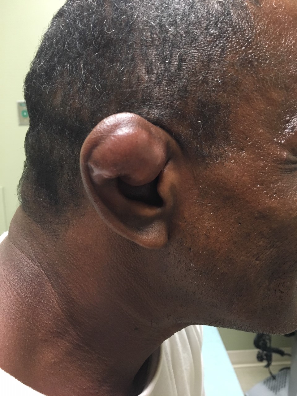 Cauliflower ear - severe