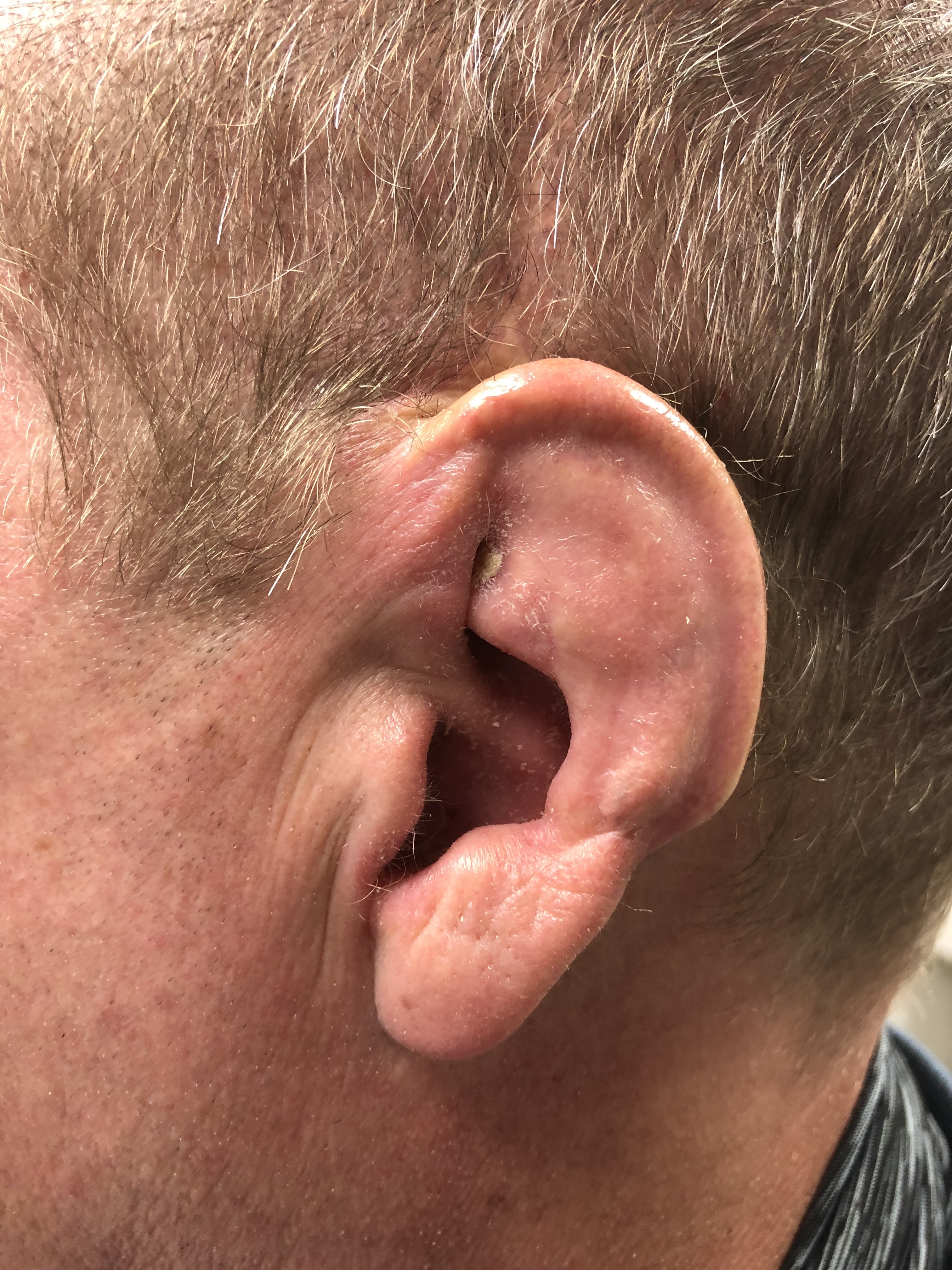 Cauliflower ear - mild