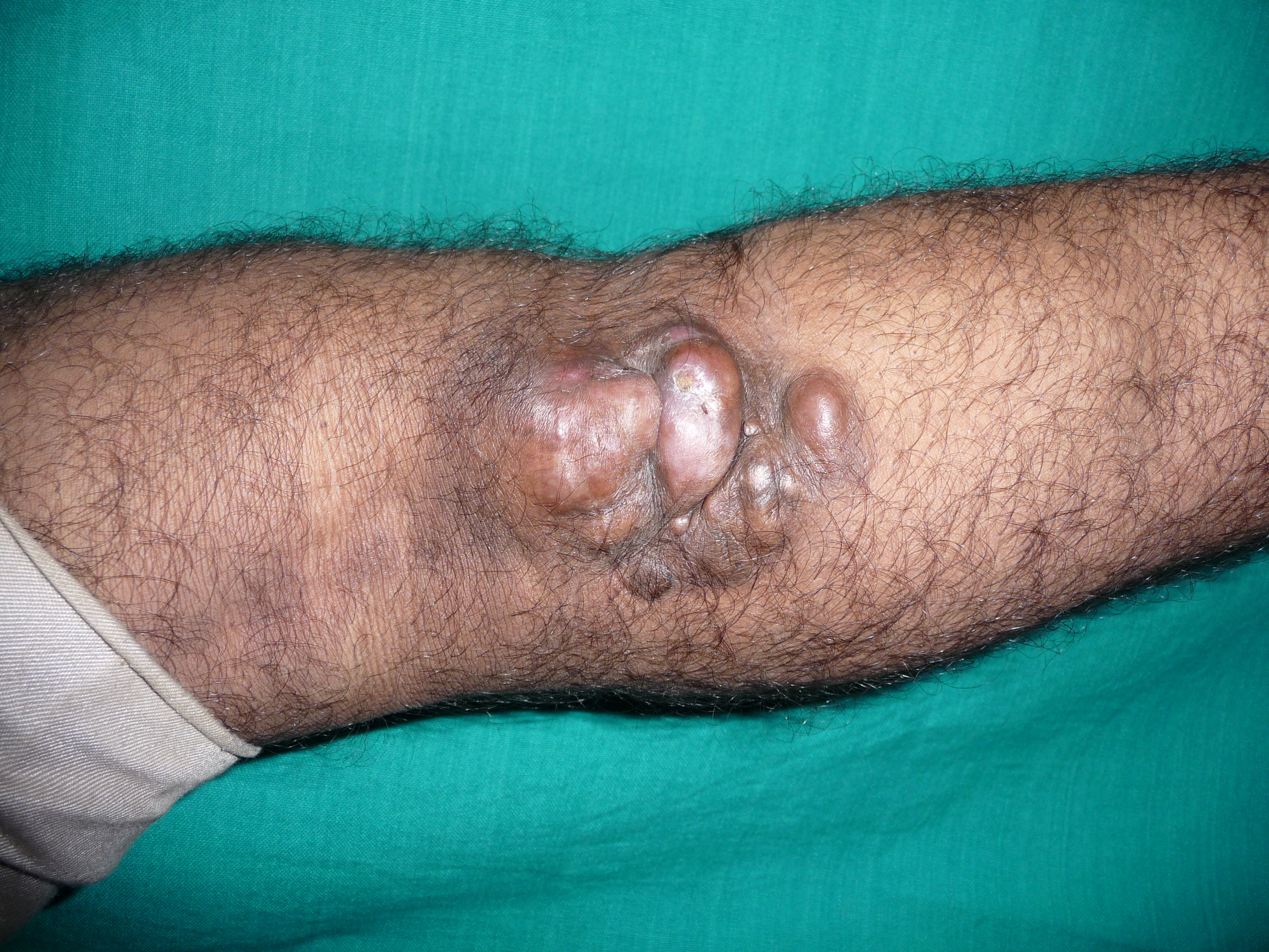 <p>Dermatofibrosarcoma Protuberans</p>