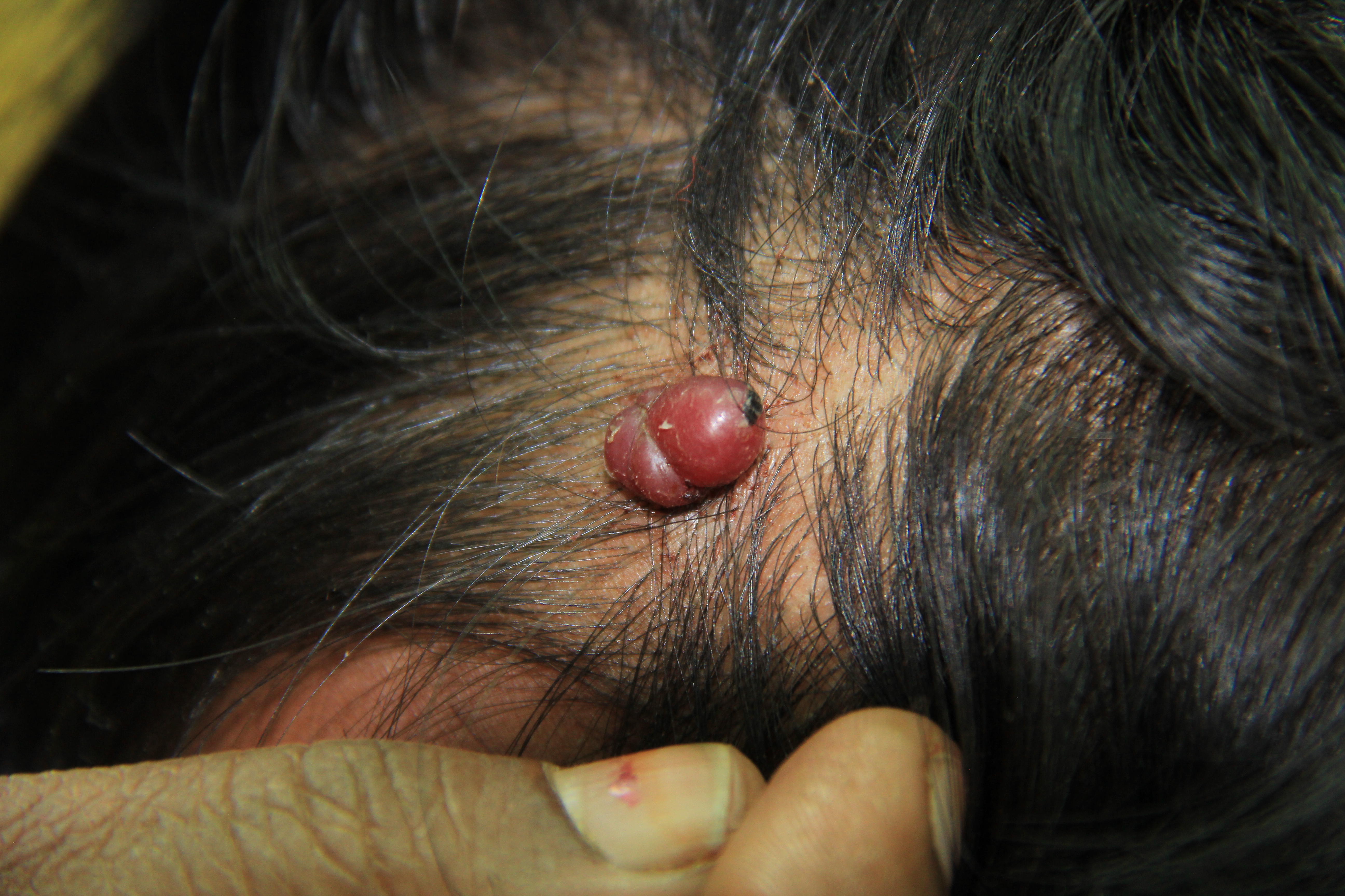 Pyogenic granuloma