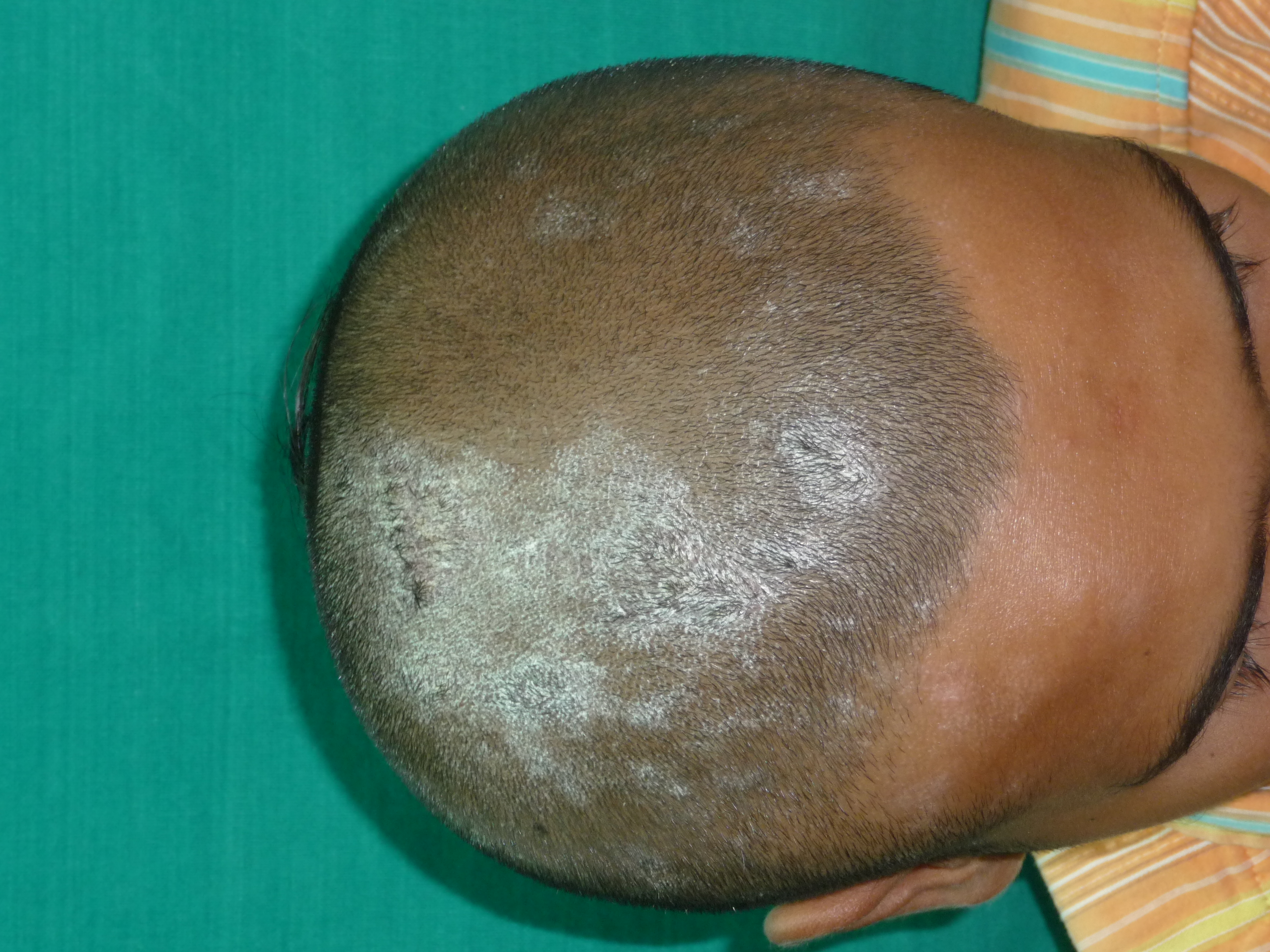 Scalp Psoriasis