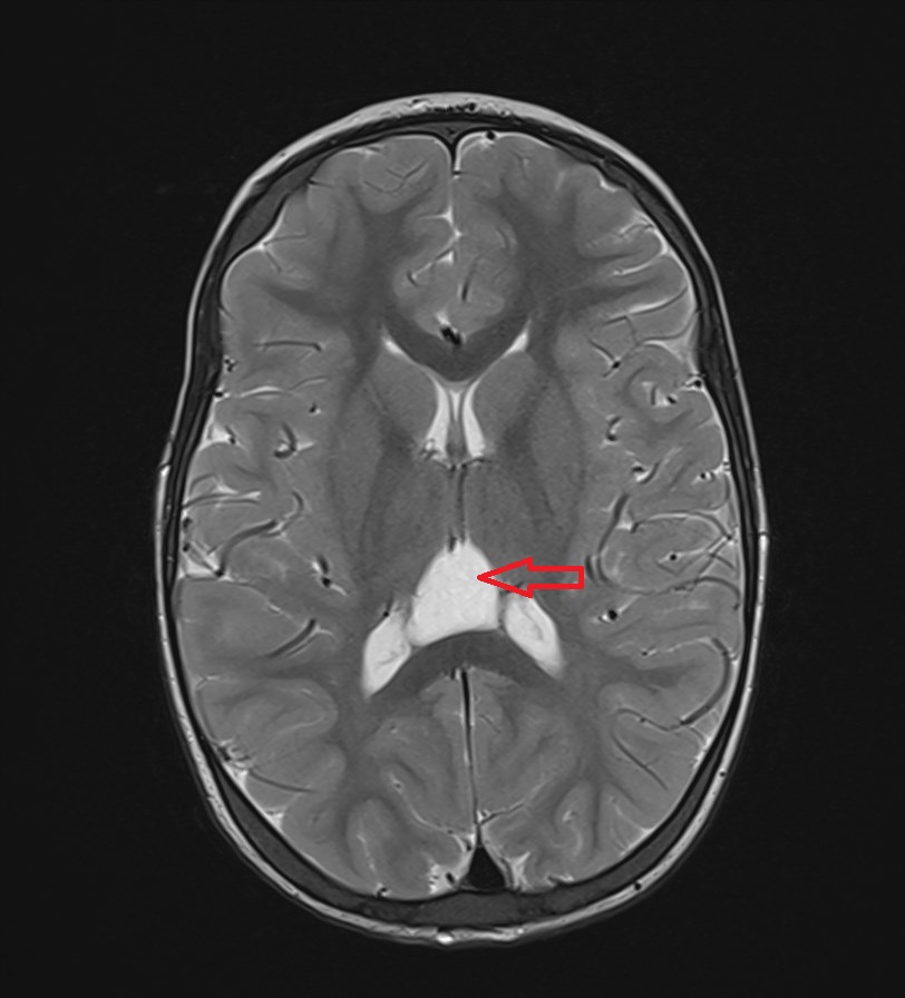 <p>Axial T2: Cavum Veli Interpositi</p>