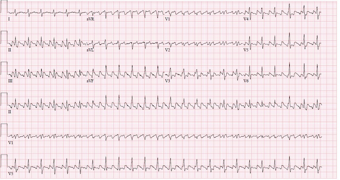 <p>Atrial Flutter</p>