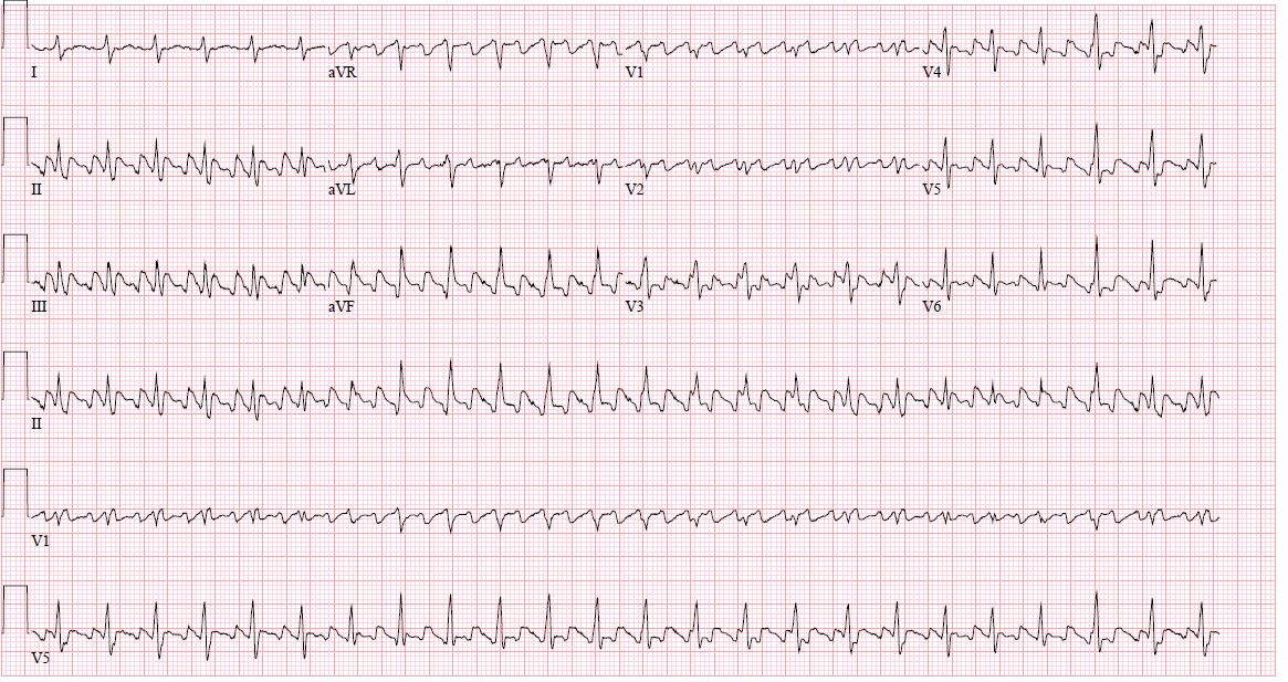 Atrial Flutter