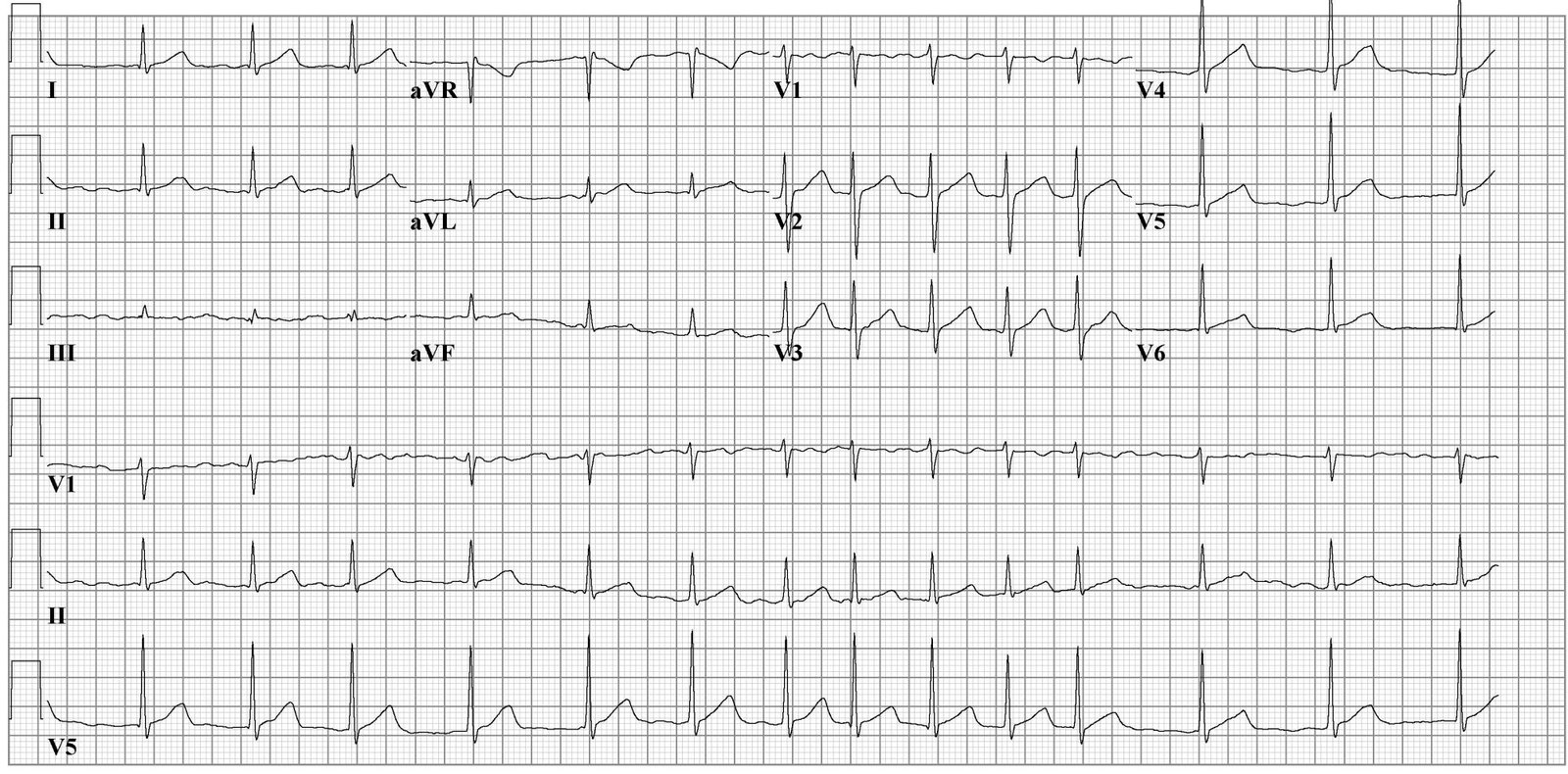 ECG for an Atrial fibrillation's case.