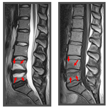 Type 1 Modic changes seen on T2-weighted (left) and T1-weighted (right) MRI highlighting degenerative changes in the vertebral endplates and bone marrow of lumbar vertebral body