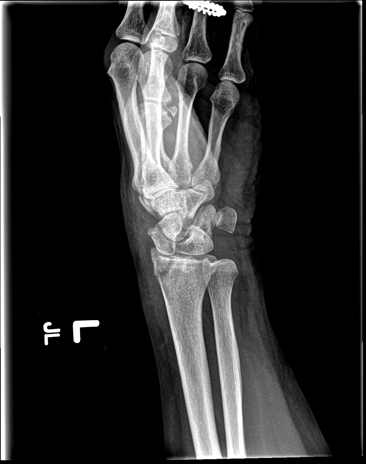 Interarticular distal radius fracture.