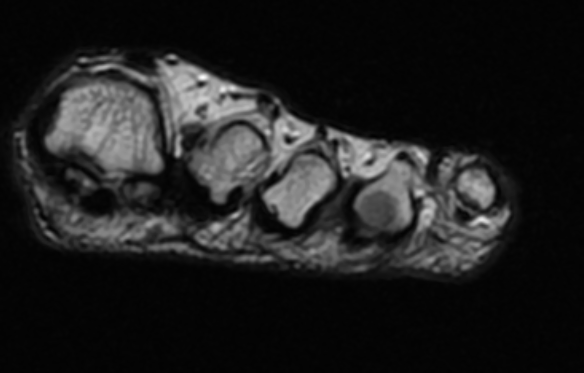 Coronal T1 image demonstrates a low signal lesion between the third and fourth metatarsals consistent with a Morton's neuroma