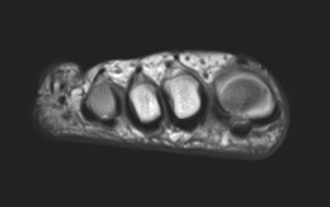 Coronal T1 MRI image demonstrates a Morton's neuroma between the third and fourth metatarsals.