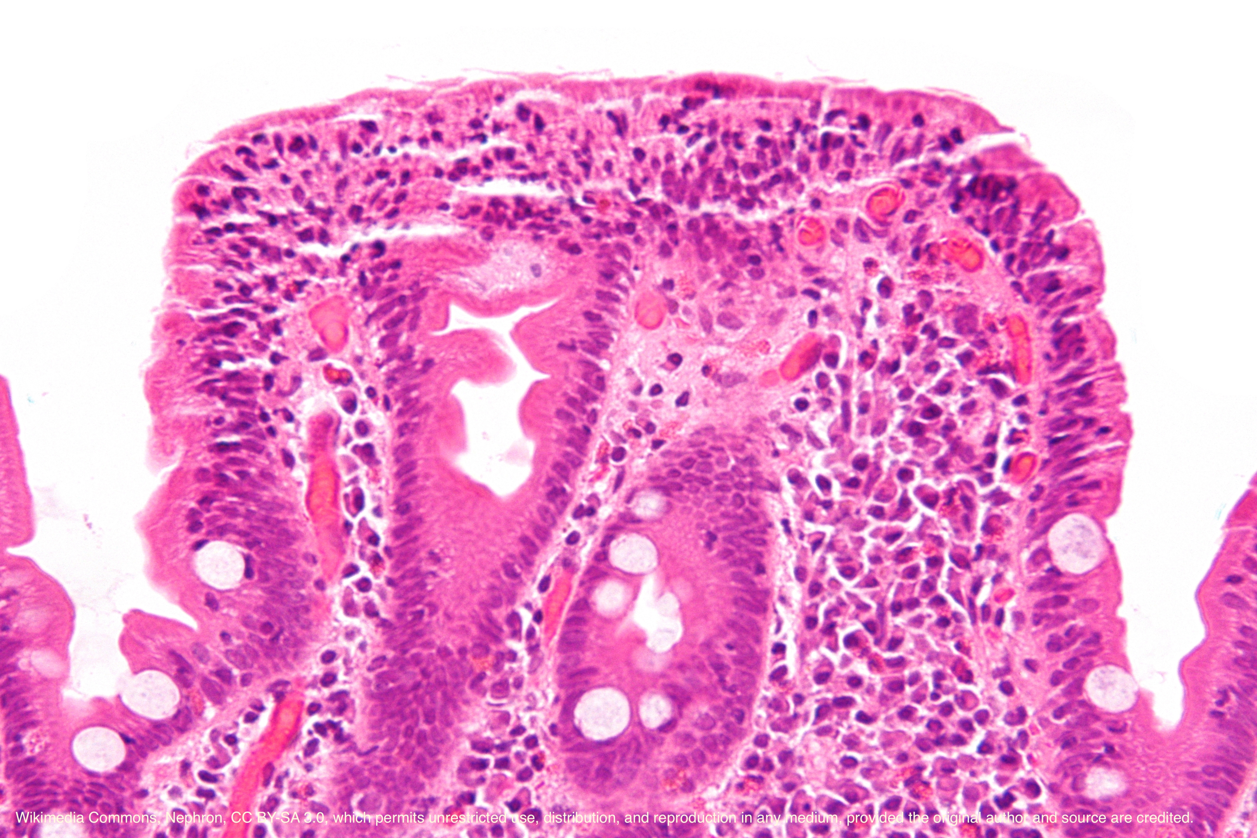 Very high magnification micrograph of celiac disease. H&E stain