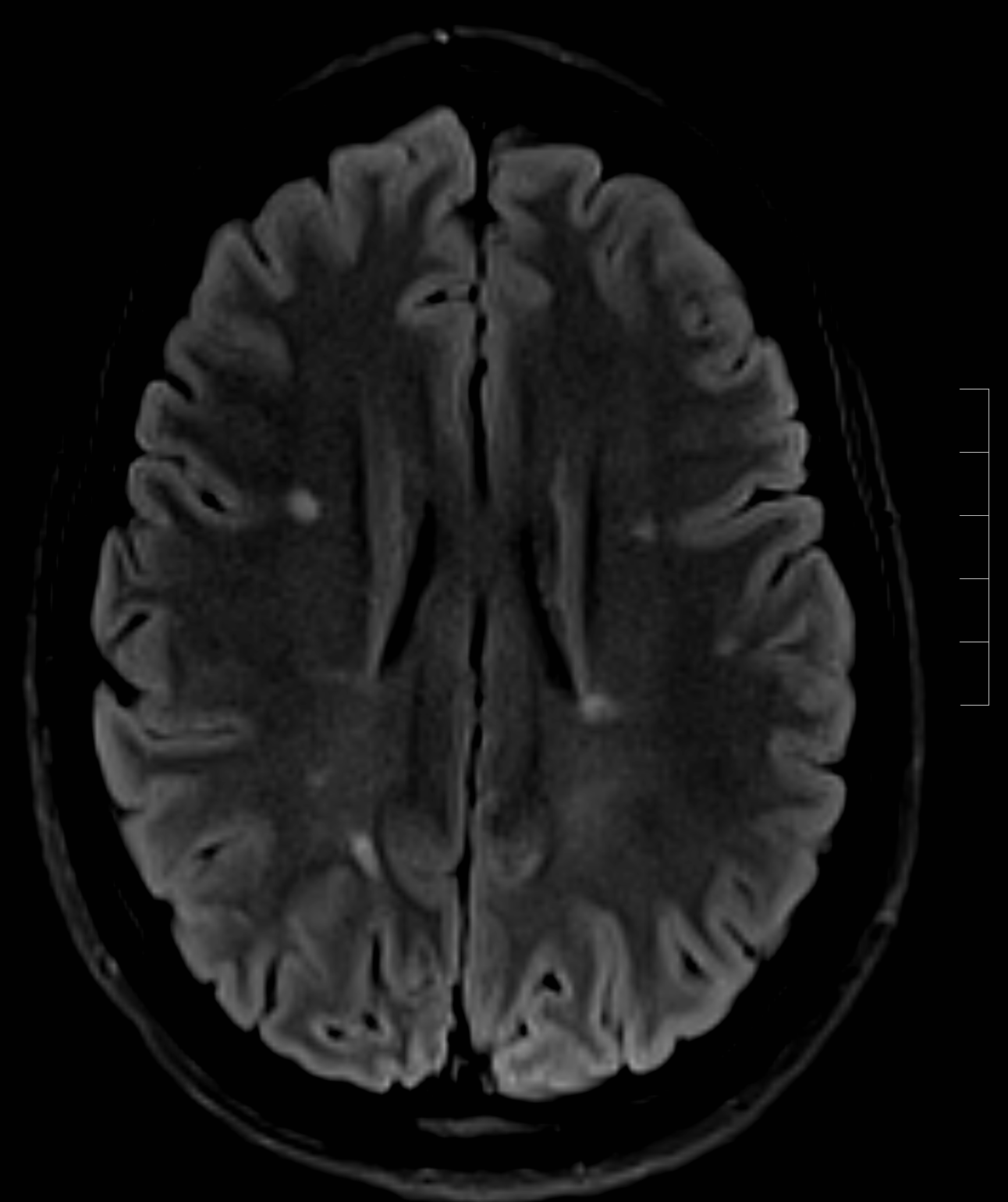 Multiple sclerosis