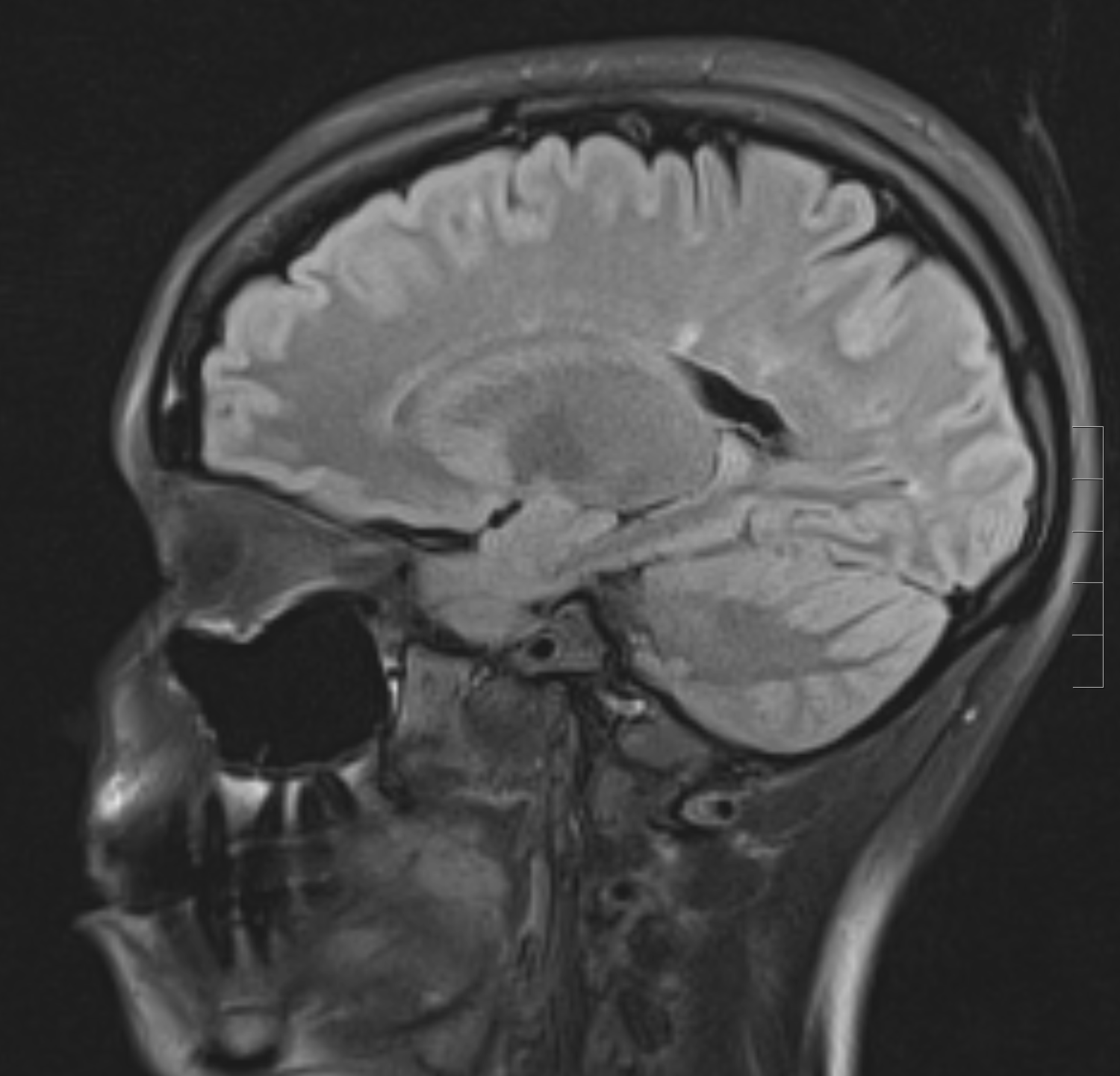 Multiple sclerosis: saggital FLAIR sequence demonstrates a hyperintense lesion perpendicular to the right lateral ventricle(These are classically called "Dawson's fingers")