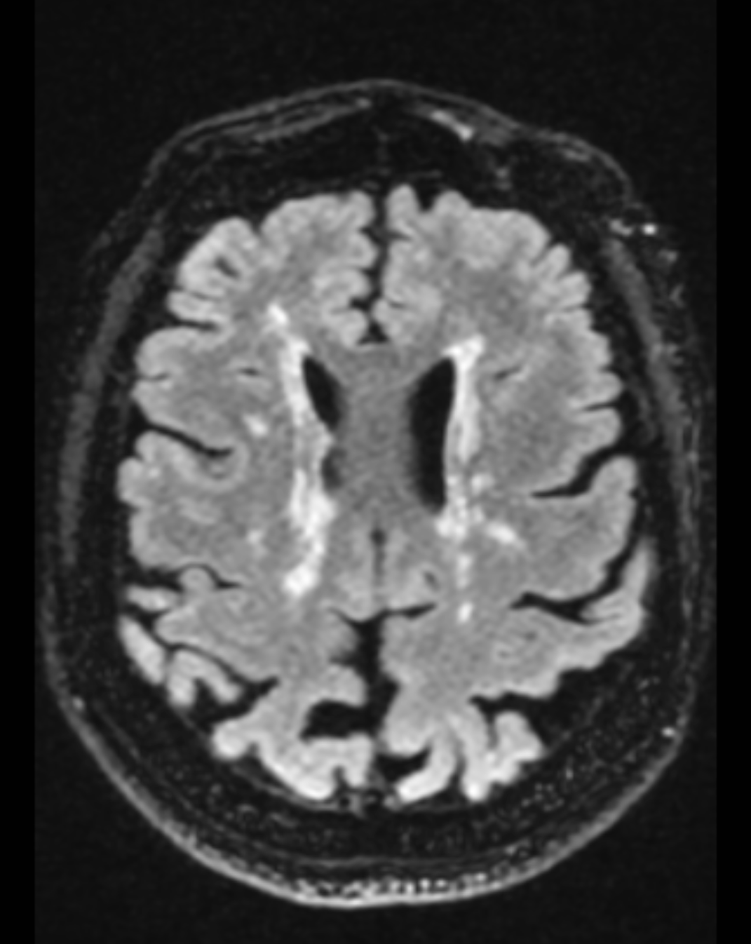 Multiple sclerosis: axial FLAIR sequence demonstrates advanced lesion burden along the callososeptal interface.