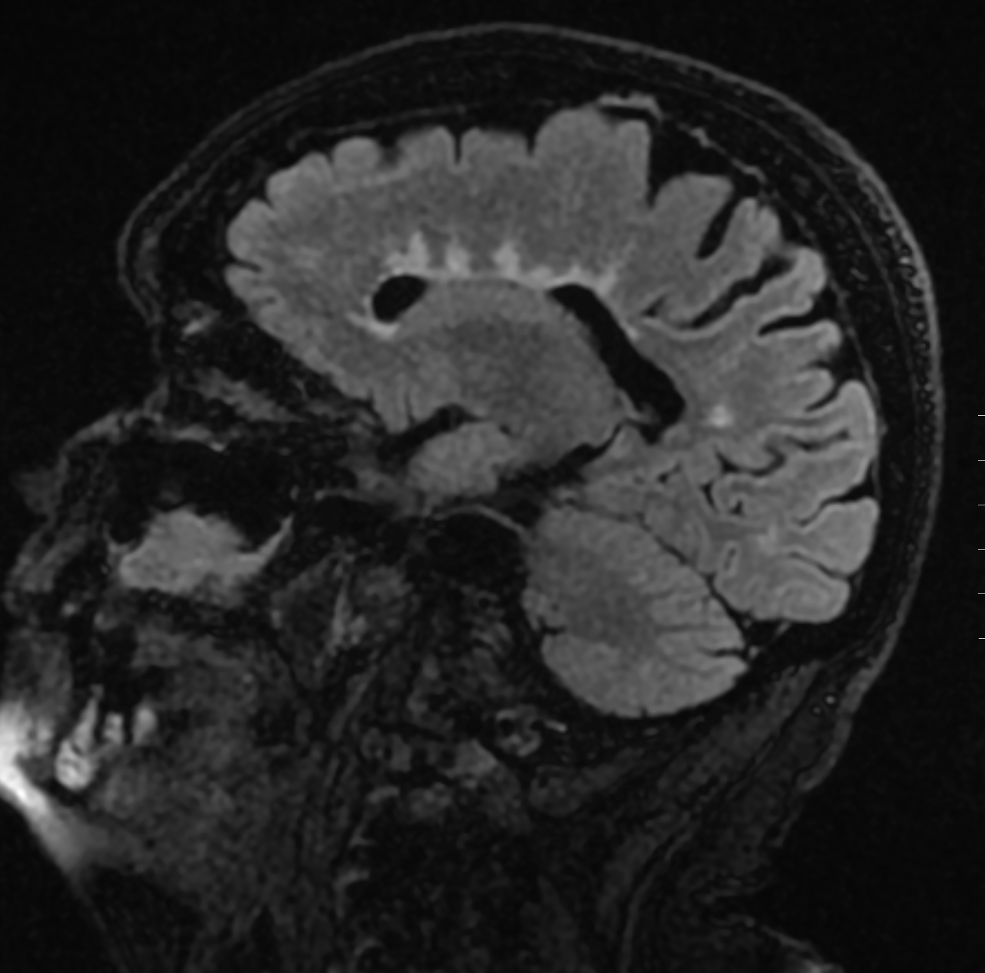 Multiple sclerosis: linear hyperintense lesions on a saggital AXIAL sequence