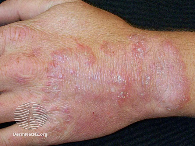 <p>Tinea manuum. Fig 1.</p>