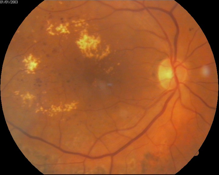 diabetic macular edema