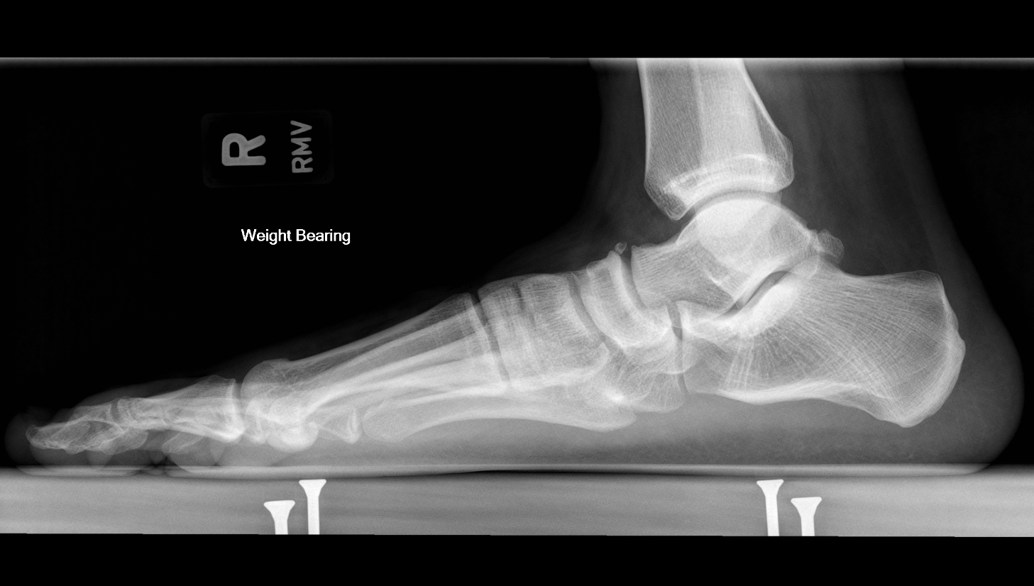 Single lateral radiograph demonstrates moderate to severe pes planus.