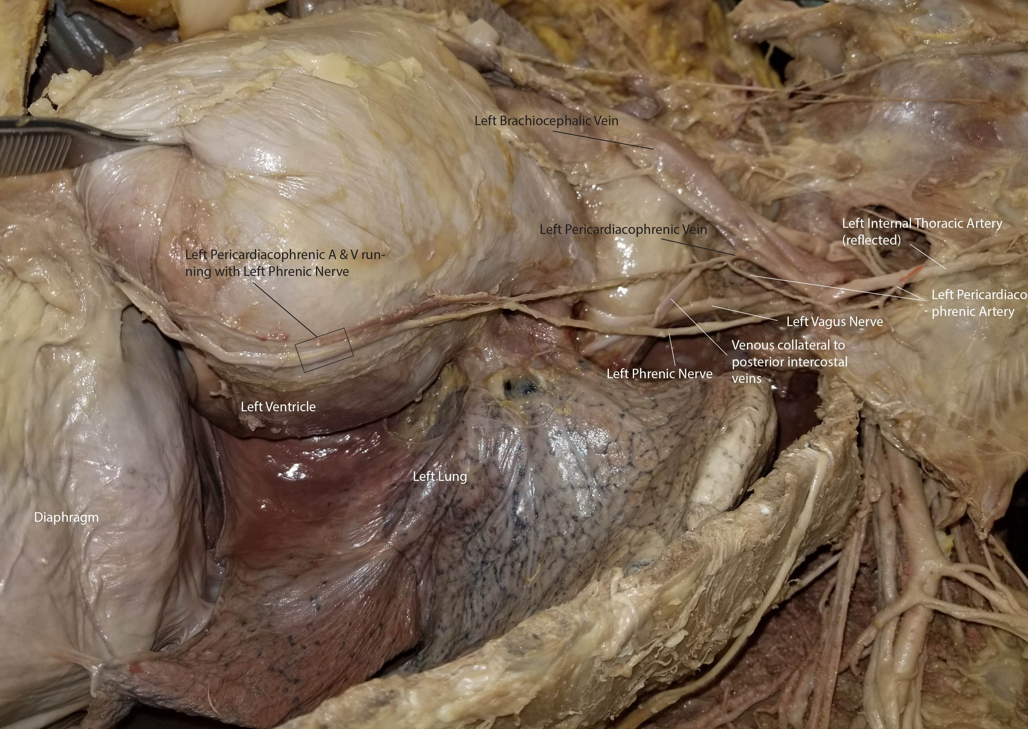 Dissected View of the Left Pericardiacophrenic Vessels with Associated Structures in the Thorax.