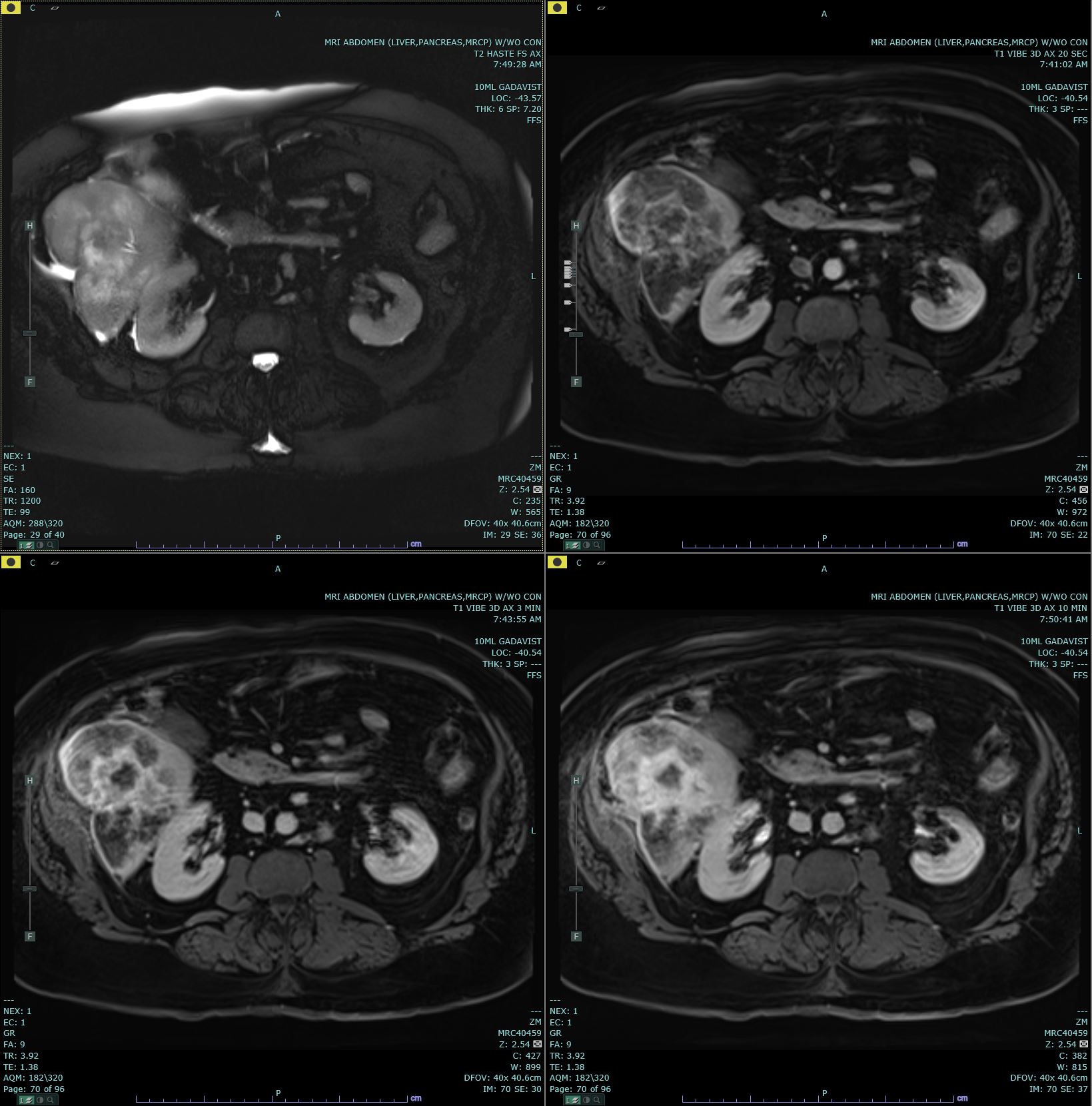 Axial T2 Haste, and 20s, 3 minute and 10 minute post contrast T1 Vibe images are submitted