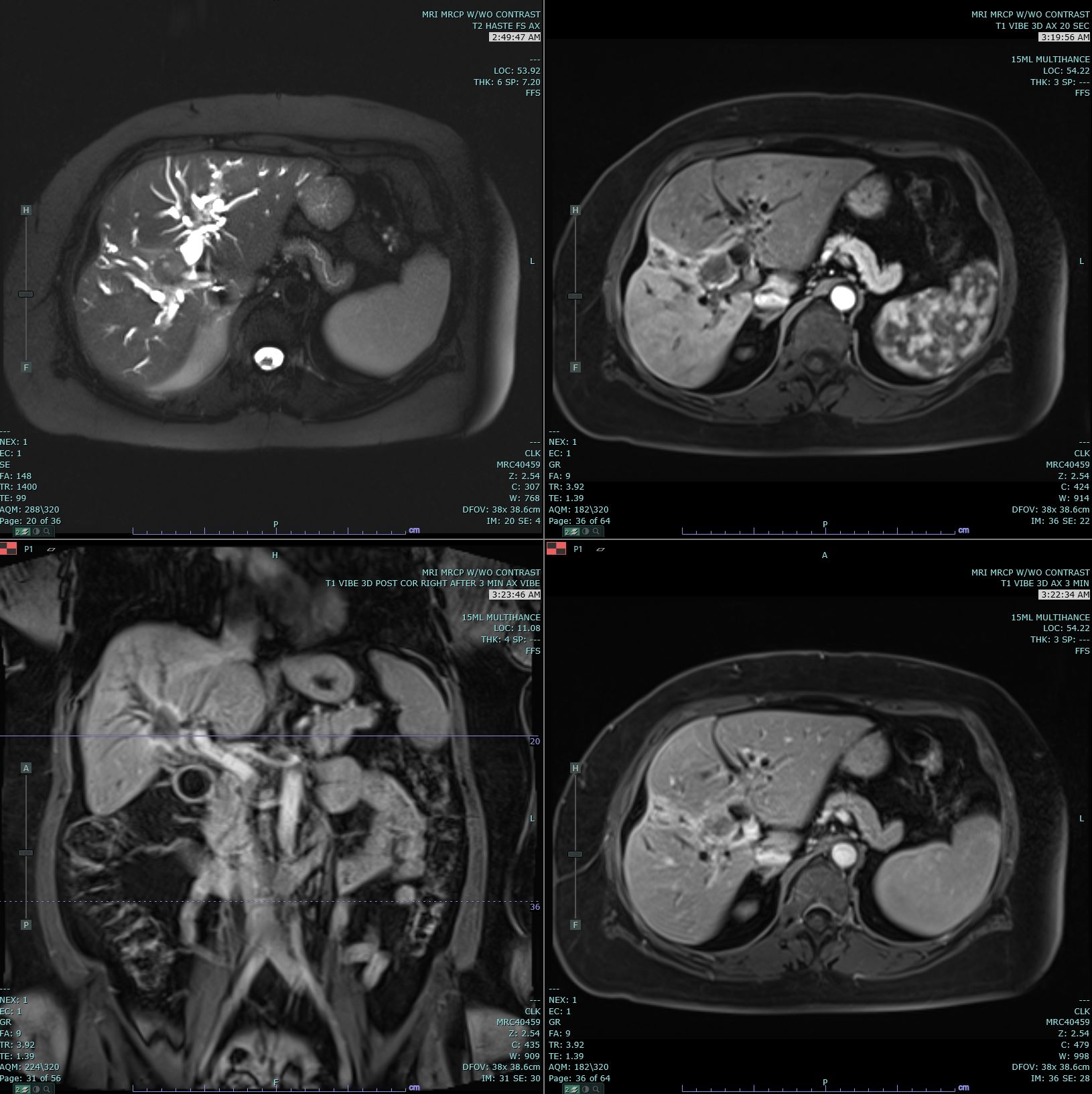 <p>Cholangiocarcinoma