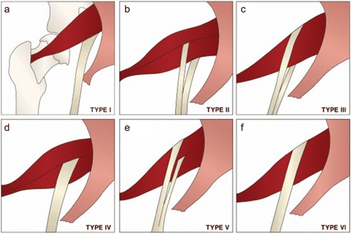 Variations on sciatic nerve anatomy, with type 1 being the most common.