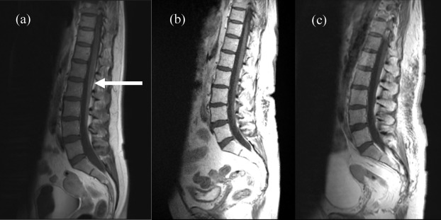 Figure 3 has a reference of PMID 22844374, A case of carcinomatous meningitis despite prophylactic cranial irradiation in small cell lung cancer during treatment with amrubicin