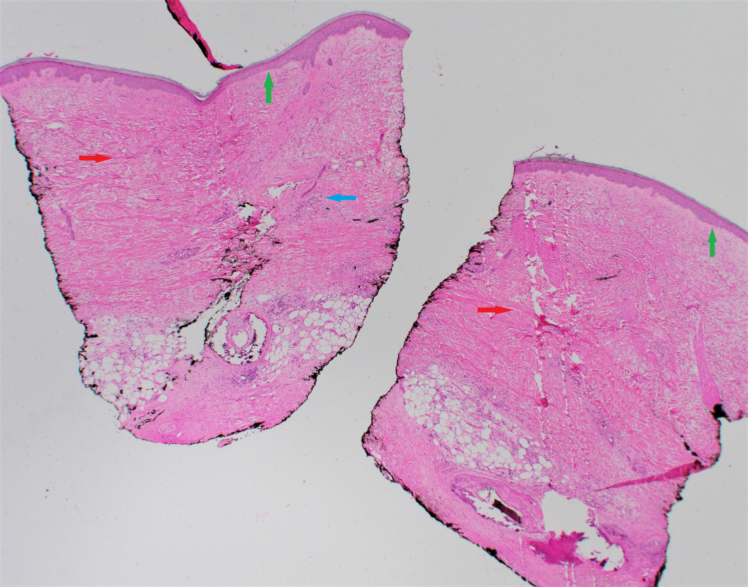 Skin biopsy showing moderate sclerosis of the dermis and subcutis (red arrows) with loss of rete ridges (green arrows) and focal chronic inflammation (blue arrows) consistent with early morphea