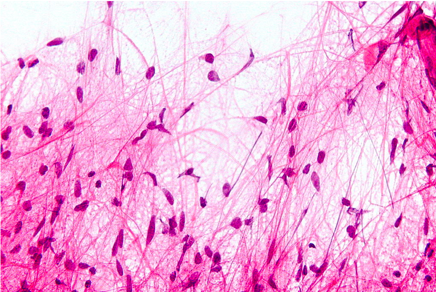 Microscopic features, with H&N staining, of pilocytic astrocytoma demonstrating ‘hair-like’ cell processes.