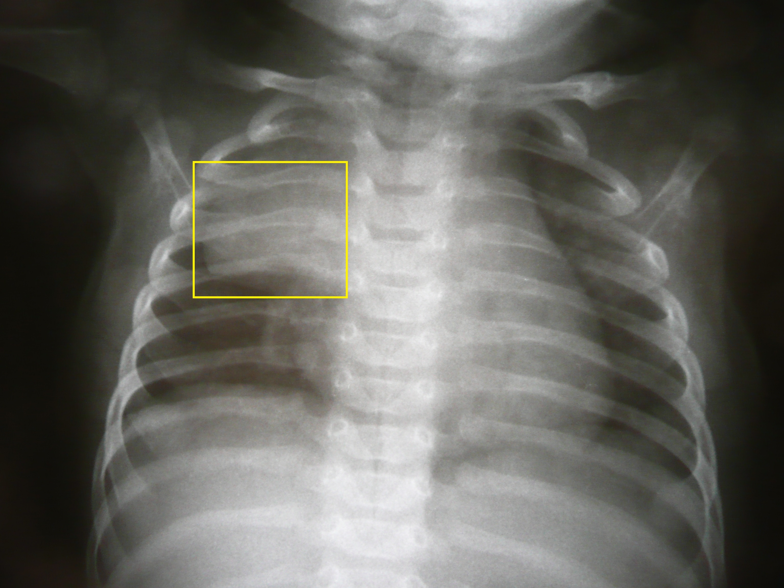 Thymic Sail Sign, Medical X-rays thymus sail sign