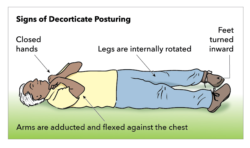 <p>Decorticate Posturing</p>