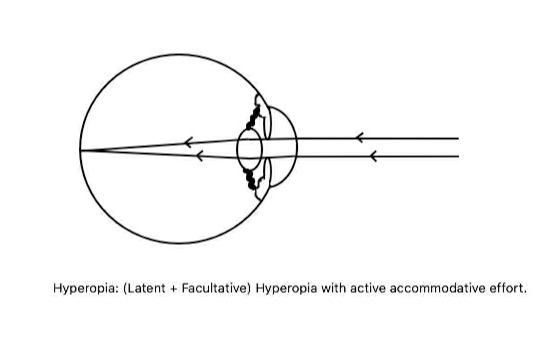 Hyperopia: (Latent+Facultative) Hyperopia with accommodation