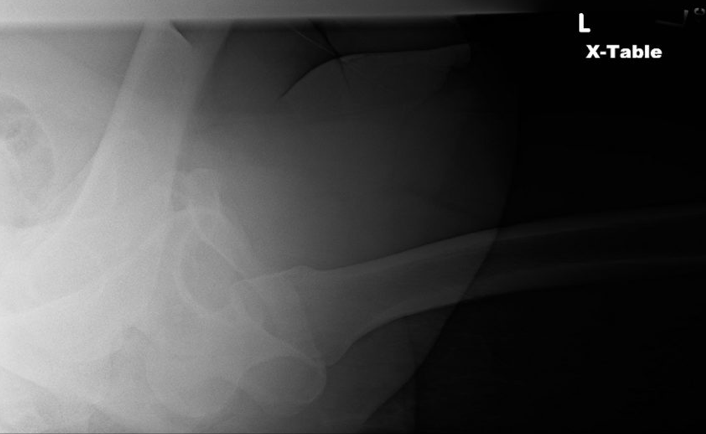 Left hip dislocation