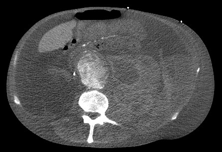 Ruptured abdominal aortic aneurysm