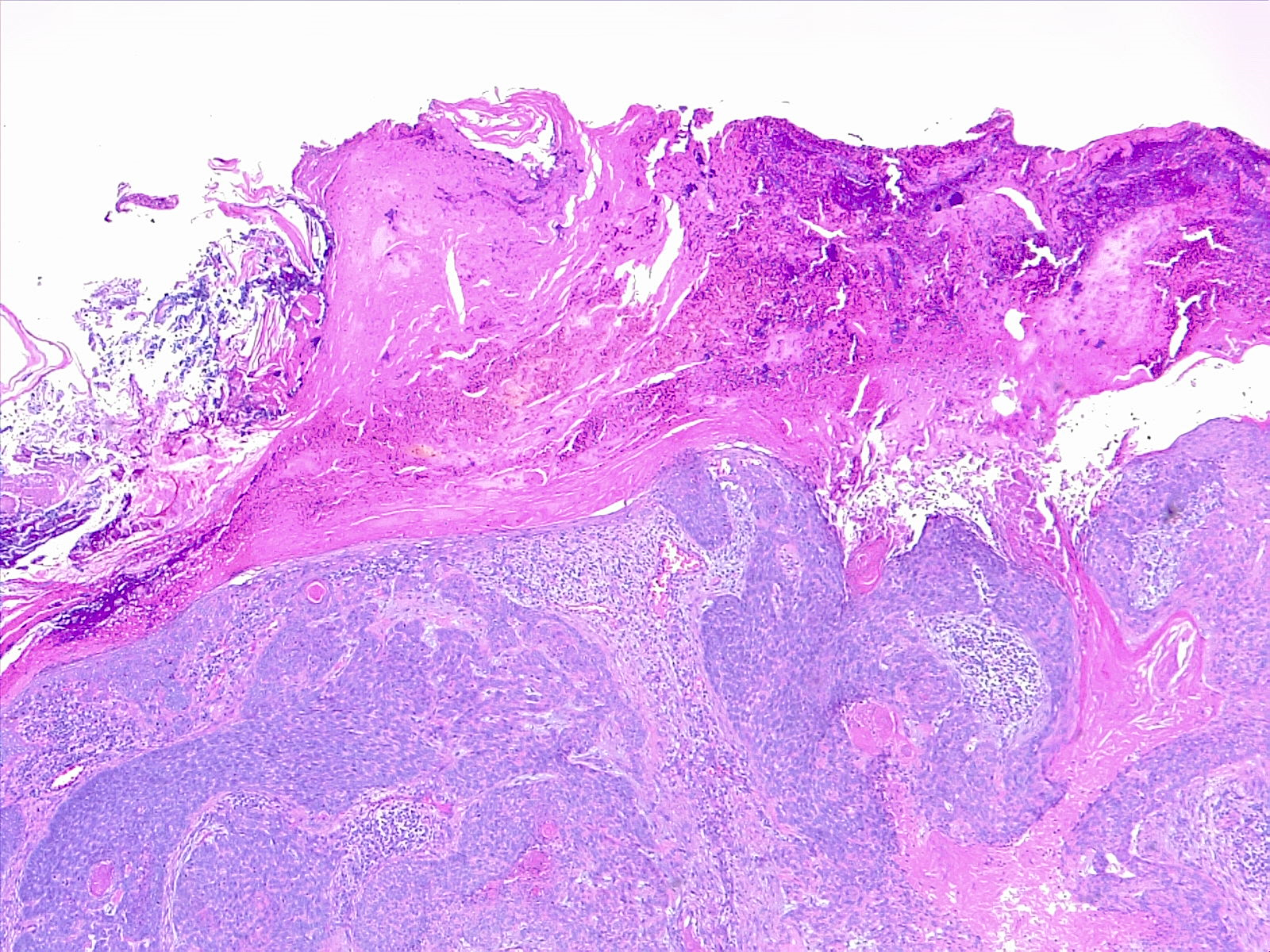 Squamous cell carcinoma of the skin