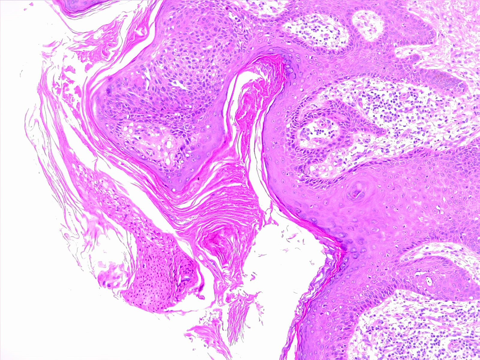 Hyperkeratosis of the skin