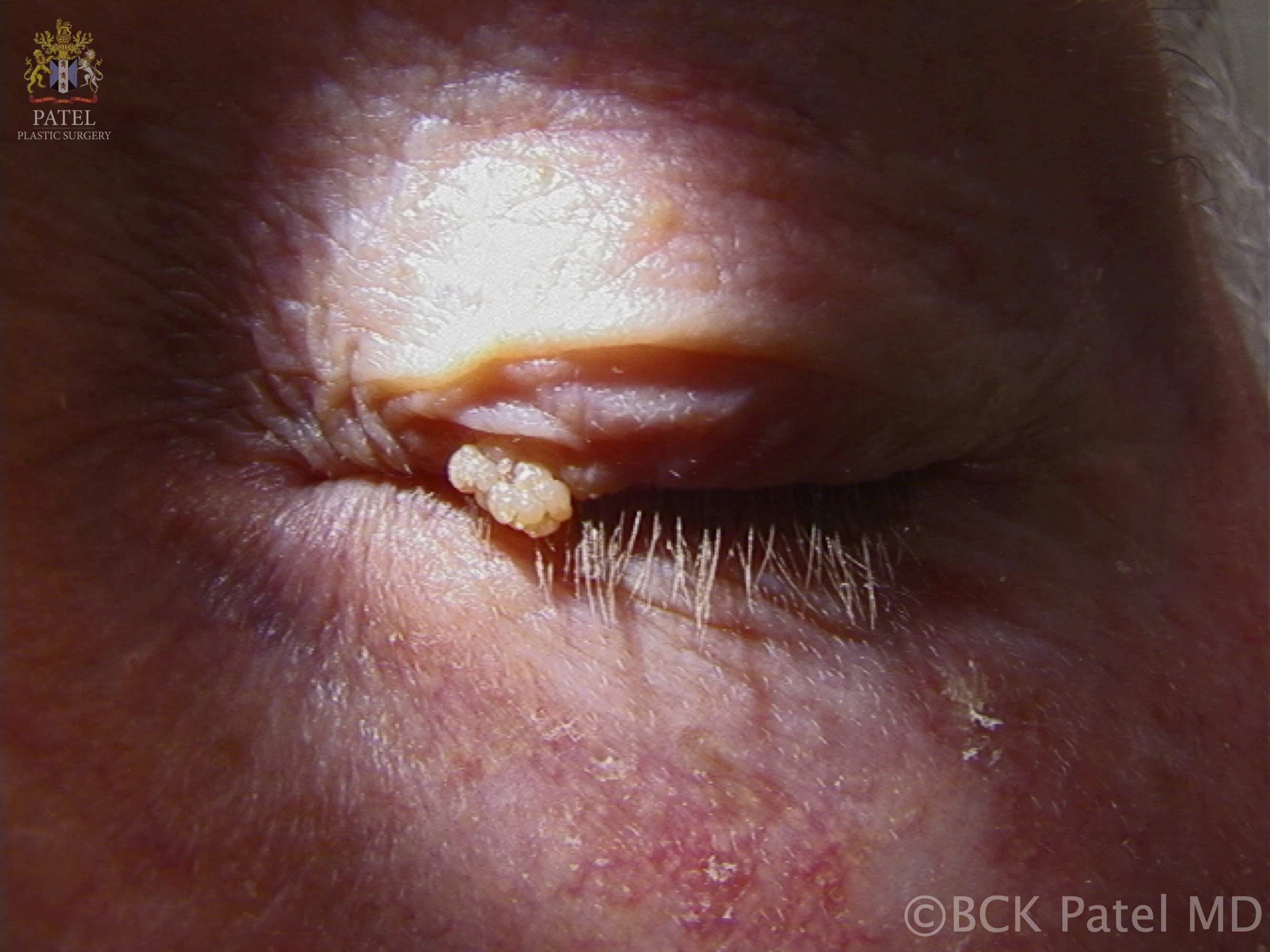 Viral papilloma: caused by human papilloma virus