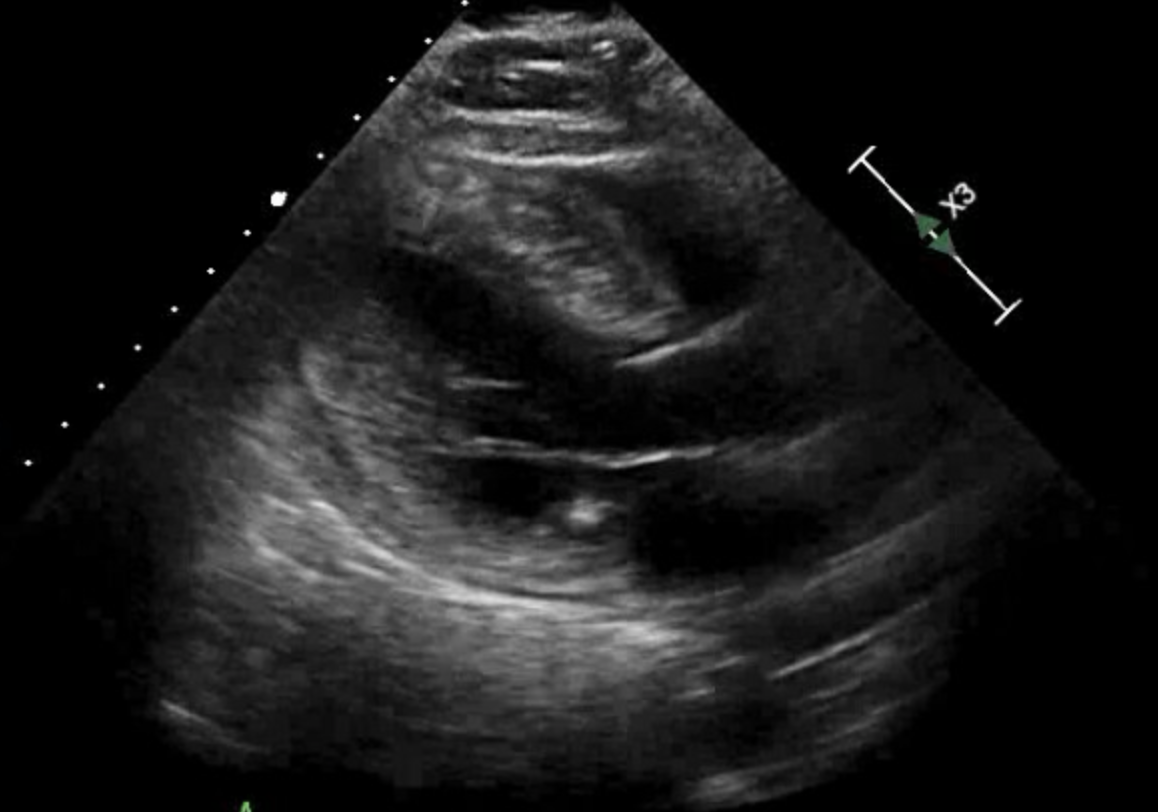 Hypertrophic Cardiomyopathy