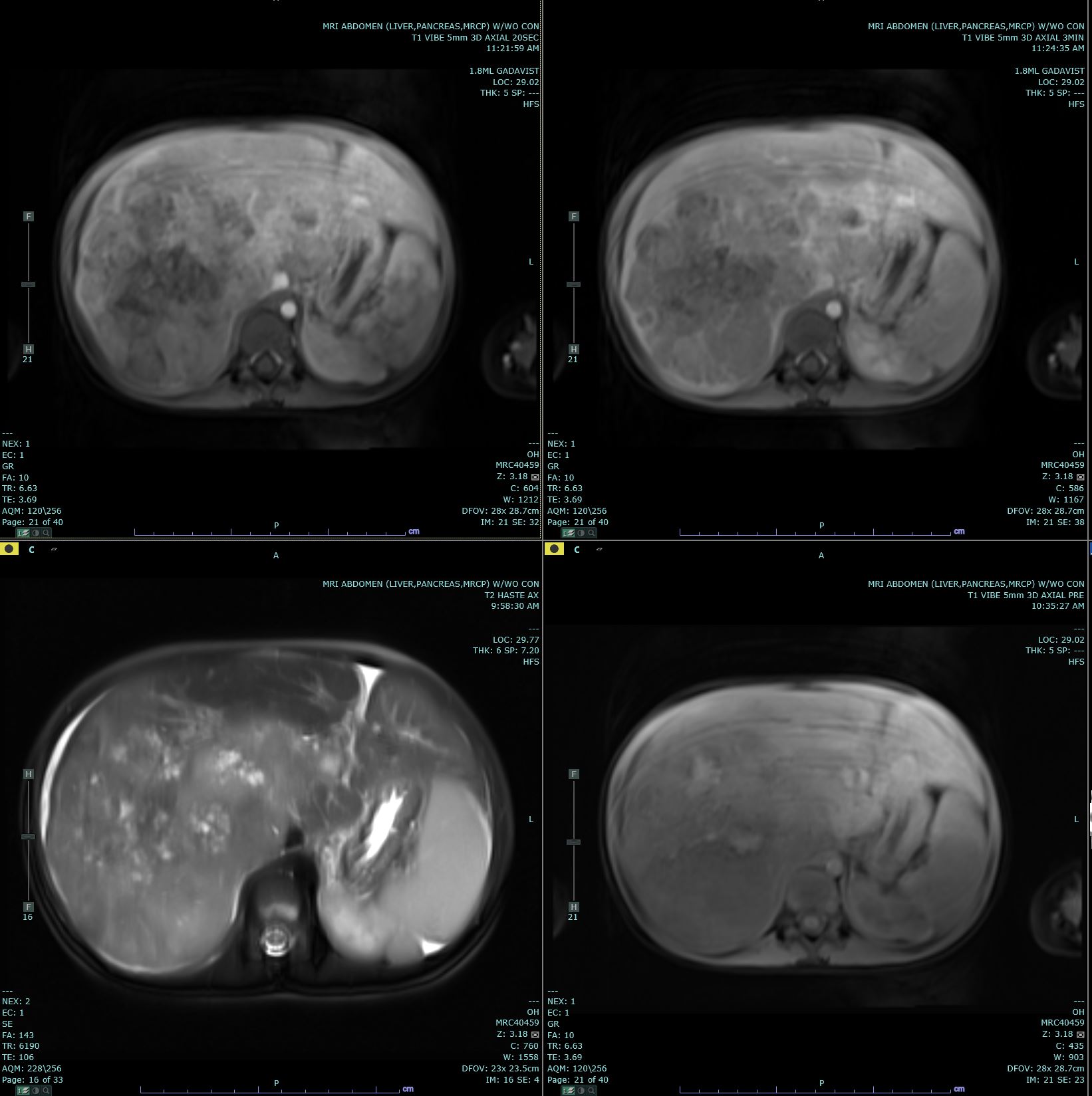 Hepatoblastoma