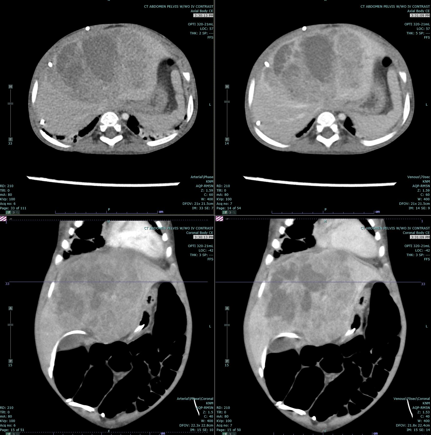 Hepatoblastoma