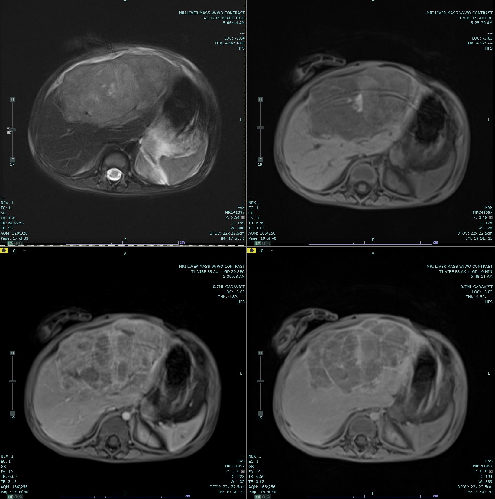 Hepatoblastoma